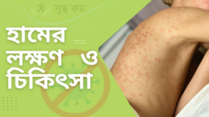 Measles symptoms and treatment